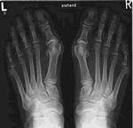 Hallux Valgus